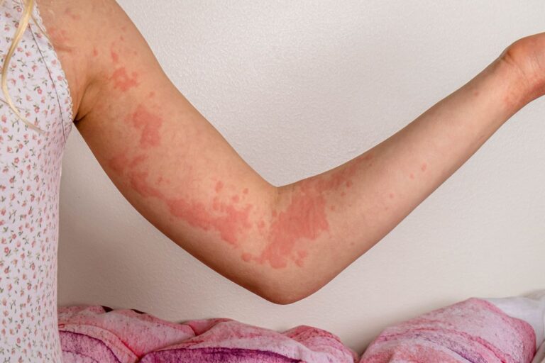 Cholinergic Urticaria