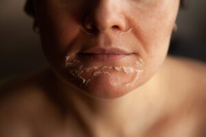 Cosmelan Peel