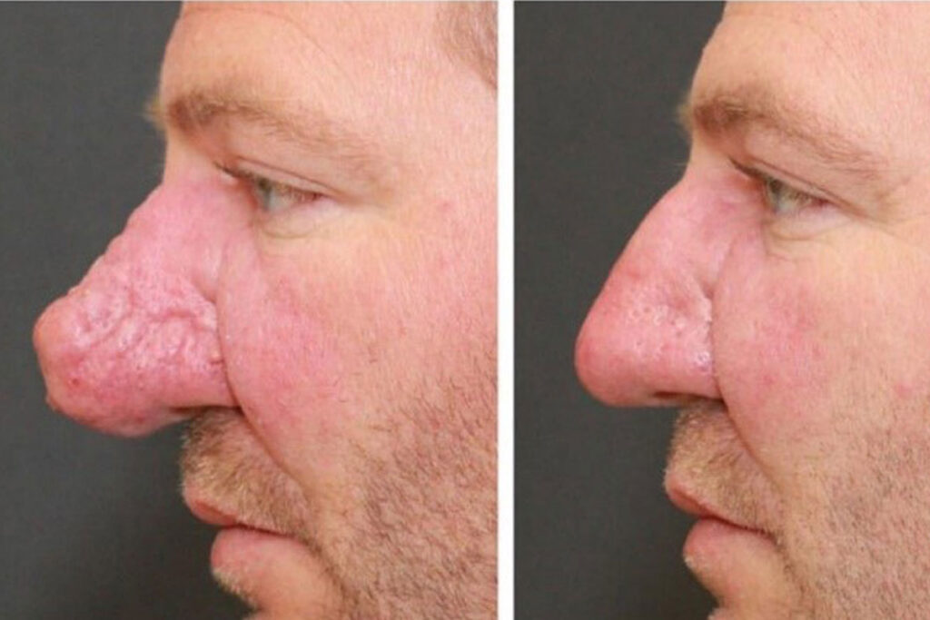 How Rhinophyma Is Treated? - Unlocking the Solutions