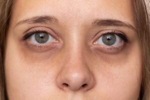Sanpaku Eyes