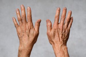 What Are Liver Spots?