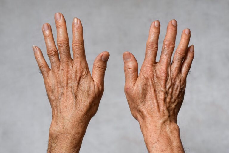 What Are Liver Spots?