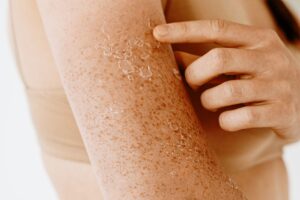 Skin Peeling
