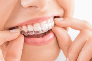 What Are the Benefits of Invisalign?