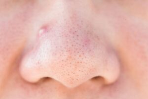 Pimple Inside the Nose