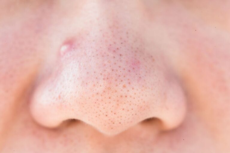 Pimple Inside the Nose
