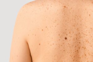 Suspicious Skin Moles